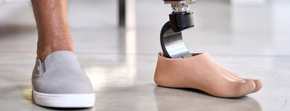 Orthopädietechnikerin passt eine Prothese beim Patienten in einem Orthopädie- und Schuhtechnikbetrieb an